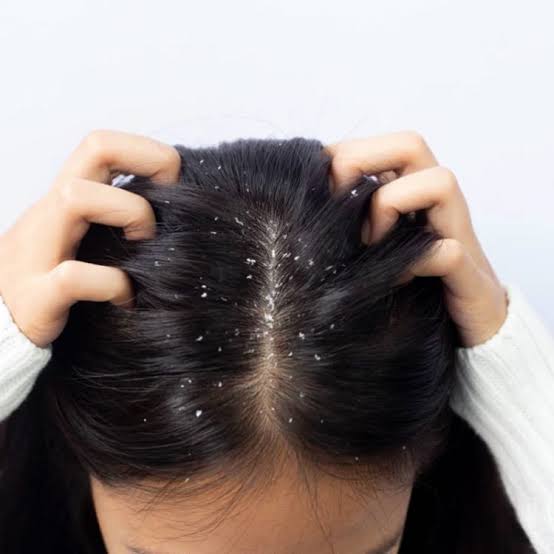 Dandruff